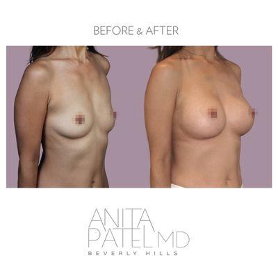 Breast Augmentation