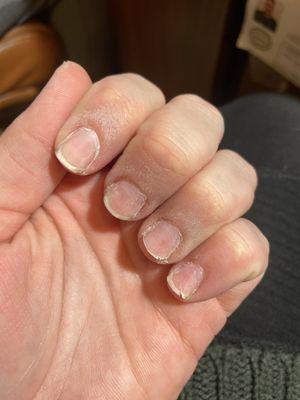 The condition of my nails after the first tech said they were ugly and drilled and buffed them until the cracked.