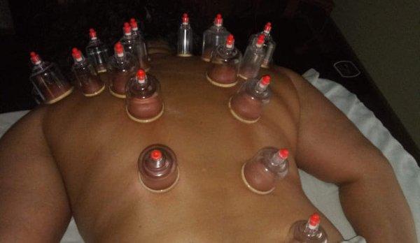 Cupping