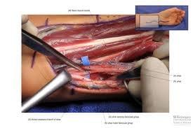 Ulnar Neurolyses