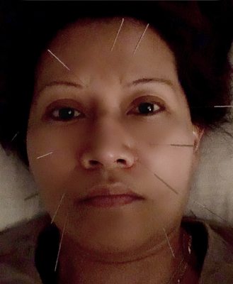 My first Acupuncture facial at age 51.  Looks scary but It didn't hurt at all.  I can't wait to finish the 6- series.