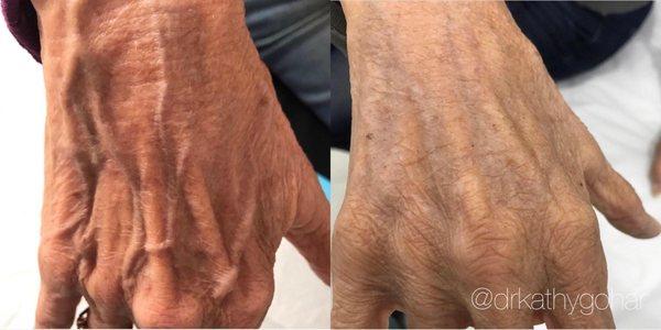 Filler for hands before and after