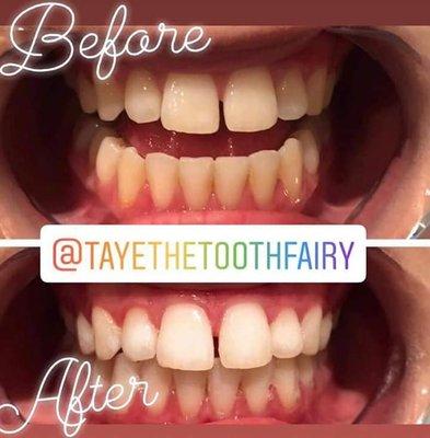 60 min teeth whitening session results