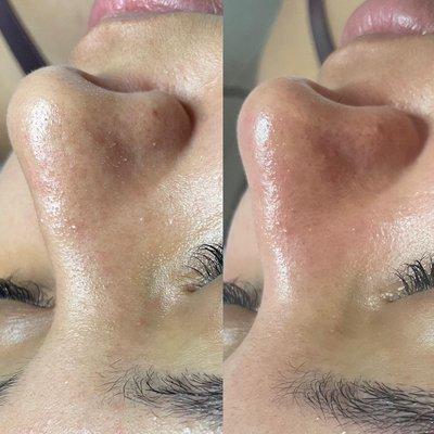 Before and after hydrofacial extractions