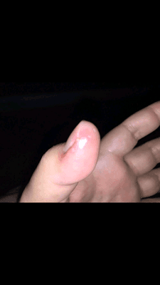 Thumb infection after 2 days