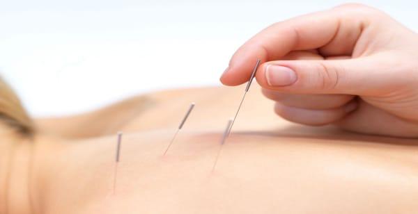 Holistic Acupuncture treatment