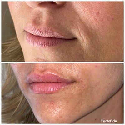 Before/after Restylane Kysse for lips