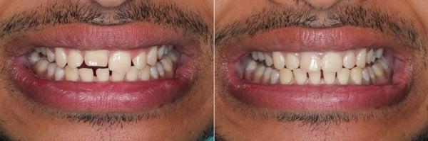 Before and After of Invisalign