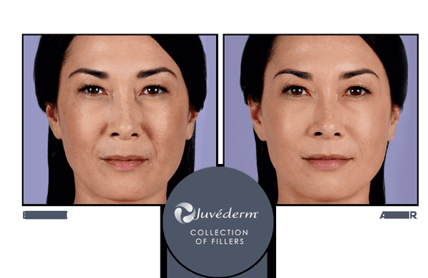 Face Logic will help reduce and remove wrinkles, plump lips, and lift cheeks with Juvéderm facial fillers.