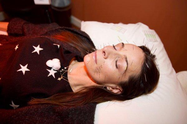 Mei Zen facial acupuncture helps reduce the appearance of unwanted lines and wrinkles