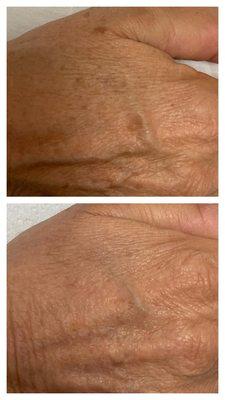 IPL Photo-Facial removes sun damage on hands and other areas of the body. Our client had 1 session. Look how great her hands look.