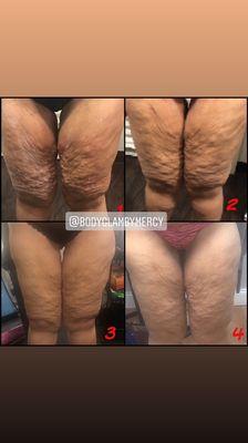 Aggressive Cellulite treatment