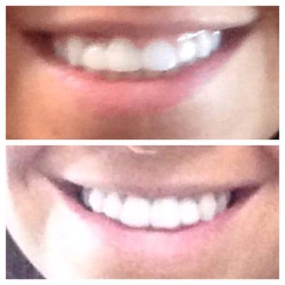 Top is before gum reconstruction and post placement for implant. Bottom is after. Such a difference!