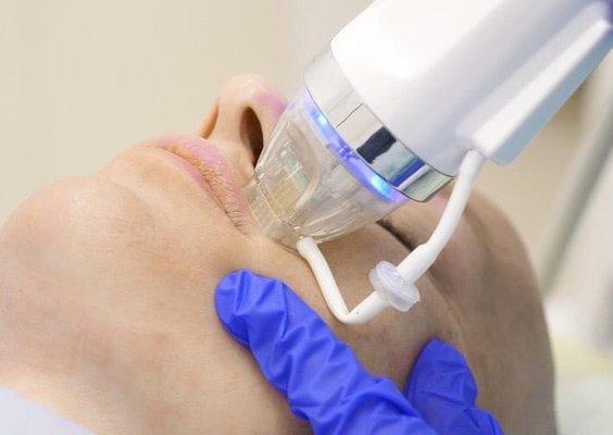 RF MicroNeedling