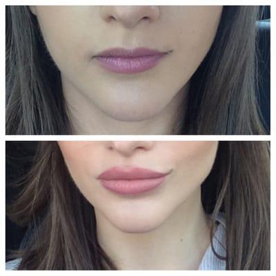 More great work by Dr. Kelleher!! I love my lips!! He is truly an artist!