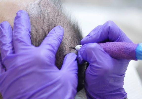 Scalp micropigmentation now offered