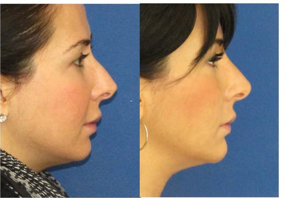 Before/After non surgical nose job and non surgical chin augmentation