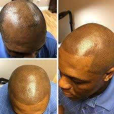 SMP Scalp micro pigmentation