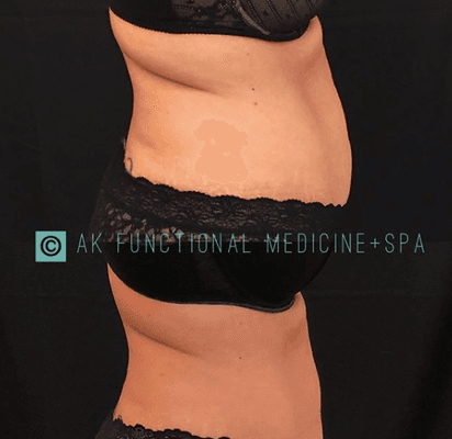 CoolSculpting before and after