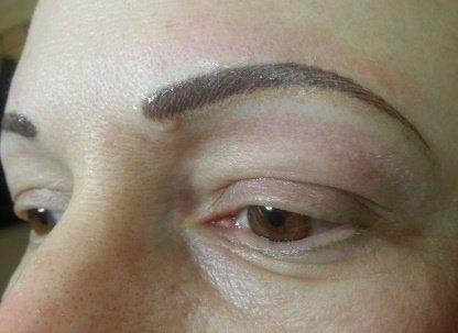 Brow correction after several corrective sessions.