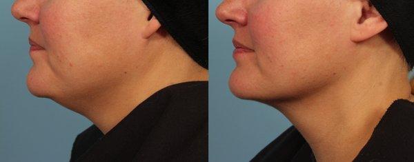 Kybella (under chin), 1 treatment