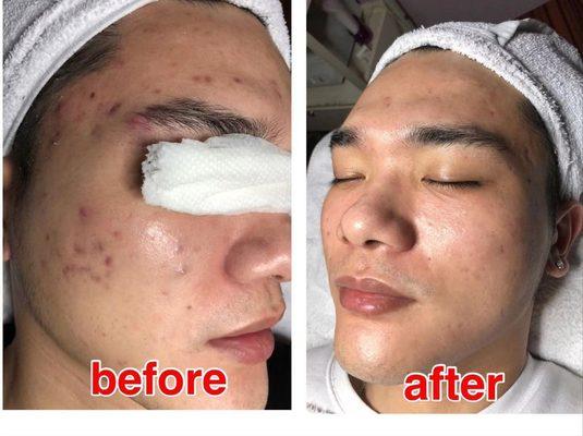 REMOVAL pimple needs、 acnes  4 TIMES