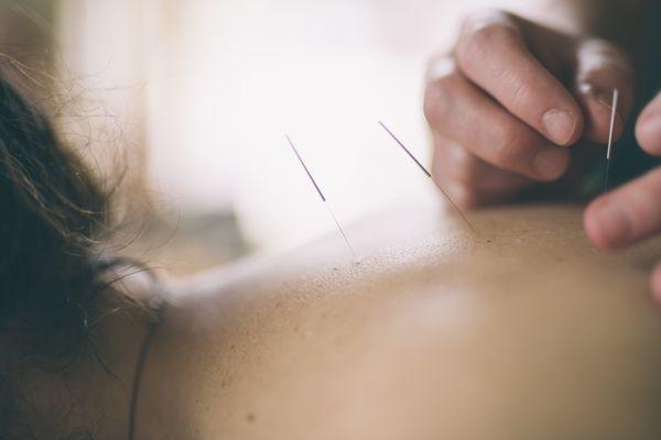 Acupuncture needles are very thin and flexible. In the hands of an experienced acupuncturist, they are virtually painless!