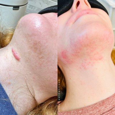 Electrolysis Before and post treatment