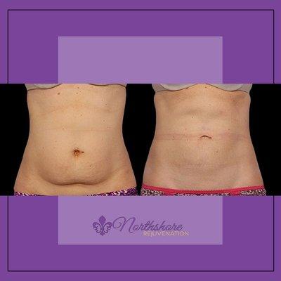 CoolSculpting Before & After