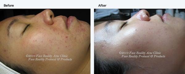 Inflamed Acne before and after