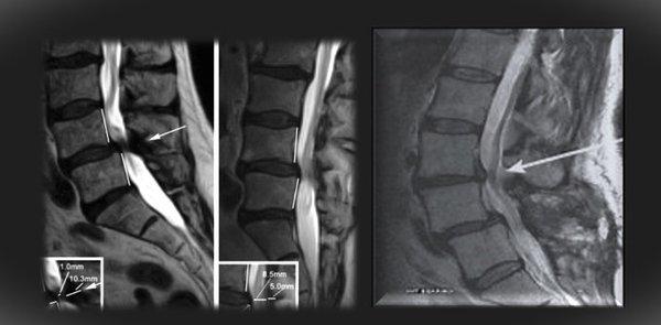 If experience increased pain while standing, important additional information may be missing from a traditional supine MRI. Weight- bearing