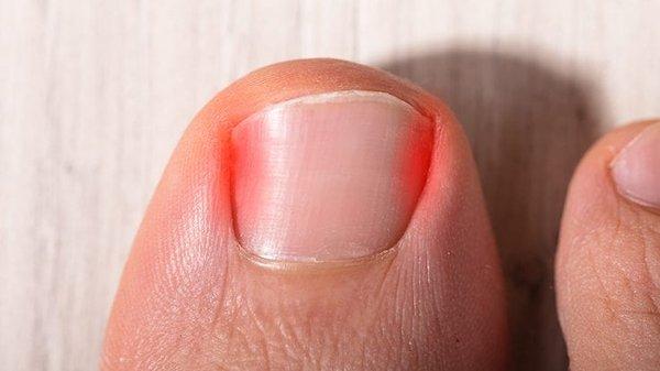 Don't live with painful ingrown nails!!!