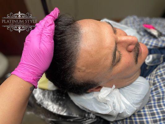 Scalp Micropigmentation (SMP)