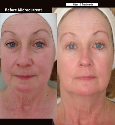 Facial Sculpting actual results after 12 treatments