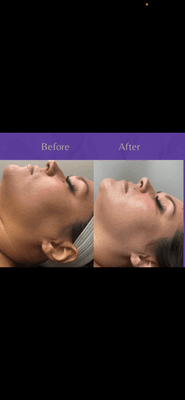 Before and after of hydration facial