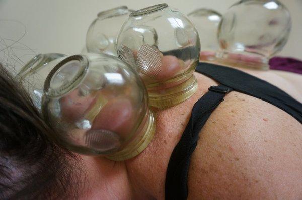 Fire cupping