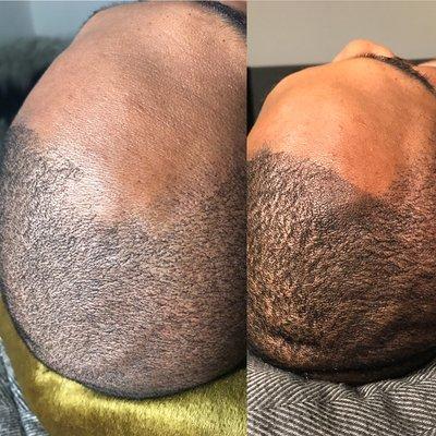 Scalp Micropigmentation Hairline Restoral