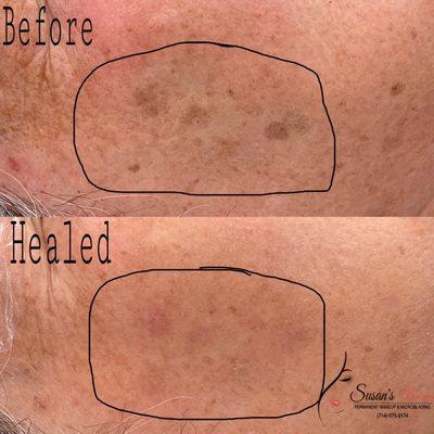 Age spot removal HEALED result after 3weeks Call (714) 675-9174 to book an appointment