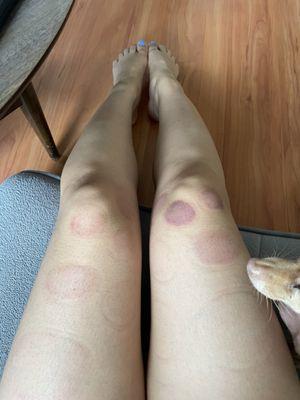 Picture of cupping on thighs, my knees have a lot of tension