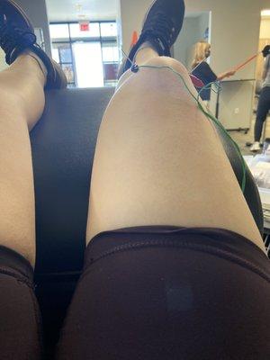 Dry needling on my other knee to help with pain!