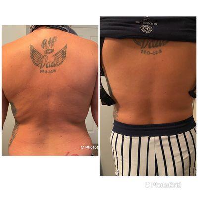 Body Contouring back (3rd Treatment)