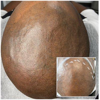 Scalp Micropigmentation SMP