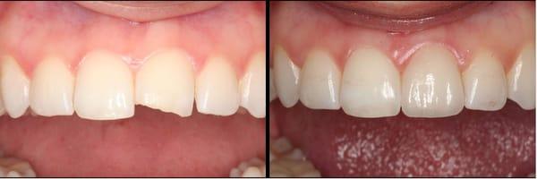 We have exceptional training in cosmetic teeth replacement procedures.