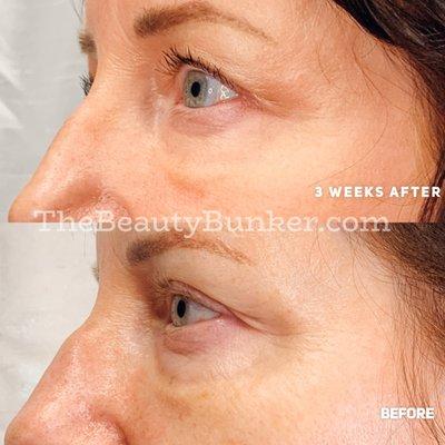 Plasma Fibroblast under eye lift