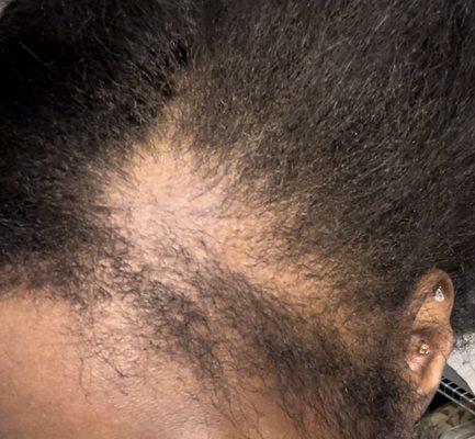 BALD SPOT. TRACTION ALOPECIA!