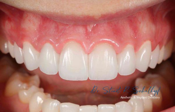 8 veneers at delivery for a patient that flew in from Ohio :)