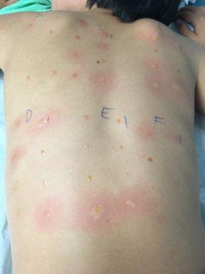 Allergy testing.  Whatever gets inflamed is what he's allergic to.  My son is allergic to alot!  I'm so glad I learned this.