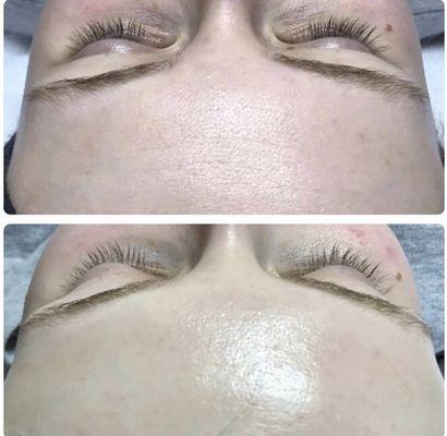 Before and after glow. Get rid of dull skin with a Hydrafacial treatment.