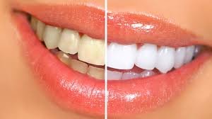 Smyle XO Professional Teeth Whitening Service