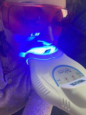 Laser teeth whitening